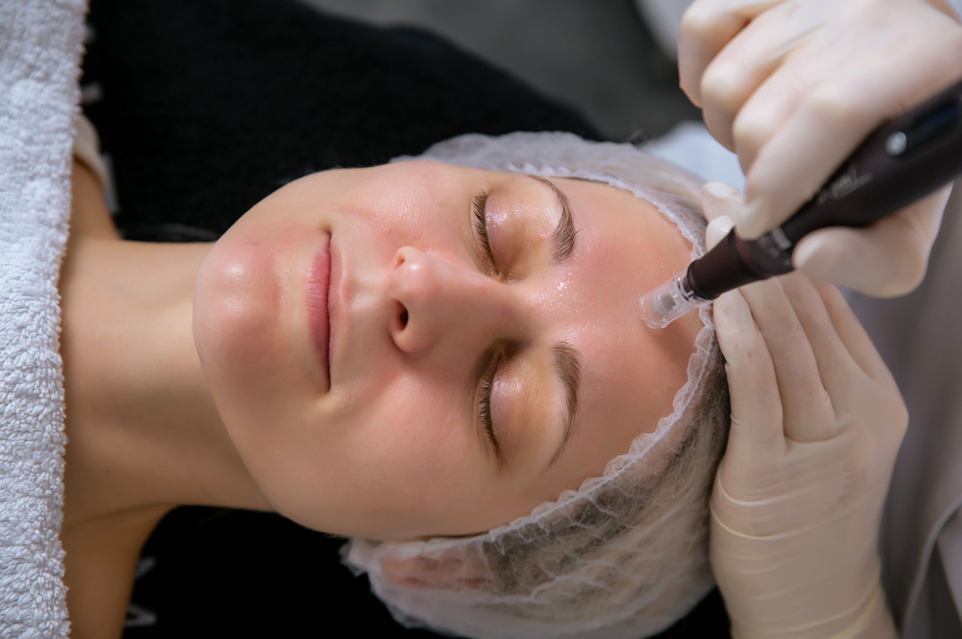 Microneedling mit Saure Microneedling mit Saure